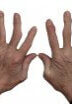 Arthritis,Of,The,Hands.